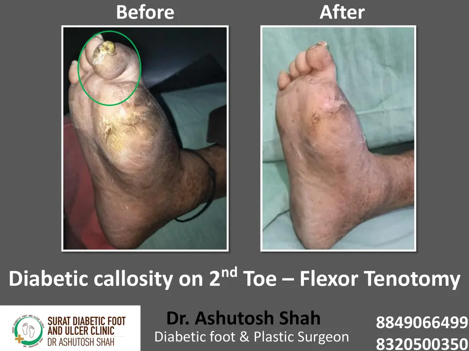 Diabetic Foot  PPT sunita.pptx-43.webp